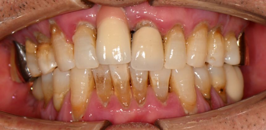Gingival recession due to periodontal disease