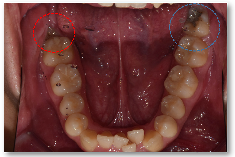 Clinical comparison of "Safe" vs "Dangerous" wisdom teeth