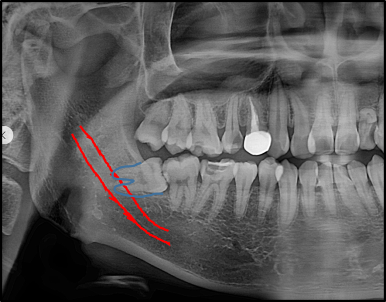 Impacted wisdom tooth with a risk of nerve damage during extraction