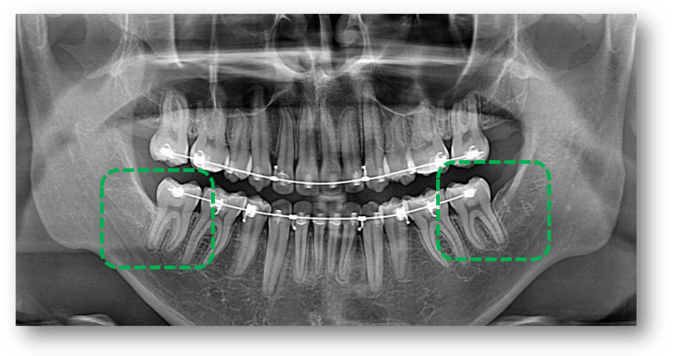 Teeth that remain healthy and free of decay after wisdom tooth extraction