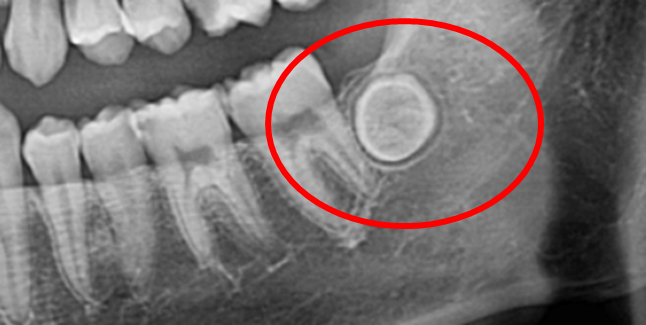 Completely impacted wisdom tooth