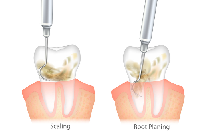 치석제거(Scaling)와 치근활택술(Root planing)